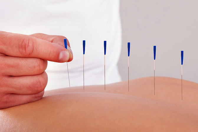 Akupunktur-Behandlung